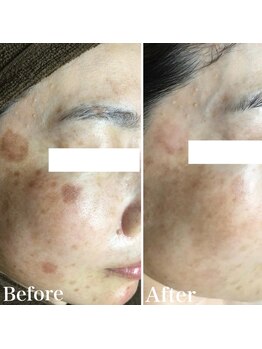 パールホワイトニングサロン 平塚店/ずっと悩んでいたシミ改善