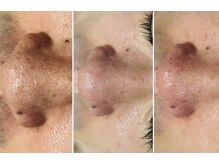 ニコ(nico)/お鼻の黒ずみ産毛の可能性も