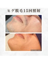 ボゴス(BOGOSS)/ヒゲ15回照射