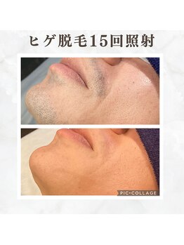 ボゴス(BOGOSS)/ヒゲ15回照射