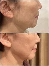 フォーユー 飯能店(Foryou)/糸使ったリフトup