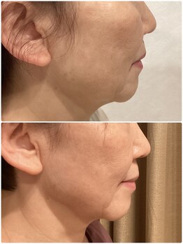 フォーユー 飯能店(Foryou)/糸使ったリフトup