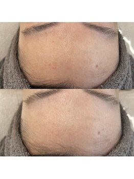 ヴェルシック(Belchic)/細胞からケアしおでこも若々しく