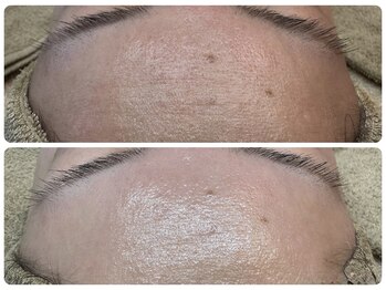 アルマ(ALMA)/肌トラブルの原因は古い垢!?