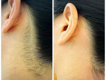 ノーサロン(NO SALON)/うなじ脱毛