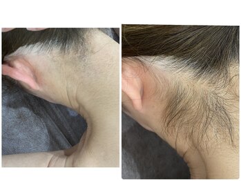 脱毛専門サロン エリクサー(Elixir)/Before After