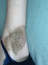 ビューティリュクス(beauty luxe)/脇の黒ずみ毛穴ハーブピーリング