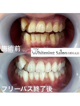 ホワイトニングサロン 京都烏丸店/ホワイトニング施術例