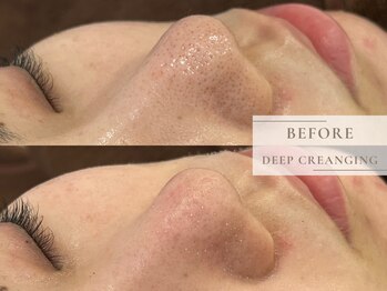 レヴィア(Revia)/にゅるにゅると浮き出る角栓