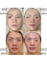 サロン ド ブラン アオヤマ(Salon de BLANC AOYAMA)/立体感フェイス