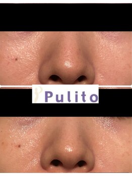 プリート 銀座店(Pulito)/頑固な毛穴のお悩み改善に