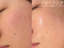 クレスト(CLEST.)/ハーブピーリング/施術3回