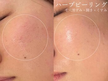 クレスト(CLEST.)/ハーブピーリング/施術3回