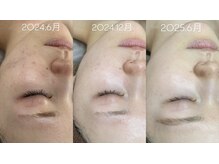 セン(Sen)の雰囲気（艶肌☆くすみのない明るいつるつる素肌を目指せる施術）
