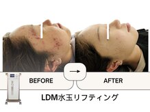 ビューティーワン(Beautyone)の雰囲気（LDMでニキビケア、肌質改善/Instagram【beautyoneldm】）