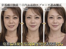 サロンチオリ 烏丸(Salon Chiori)/口内から表情筋のひきつれ改善