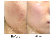 アトリエリン(Atelier Rin)/リベルハーブピーリング