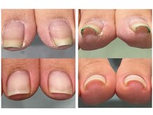 サロン ネイル ルーム(Salon nail Room)/巻き爪補正ございます