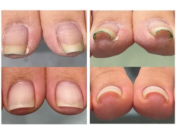 サロン ネイル ルーム(Salon nail Room)/巻き爪補正ございます