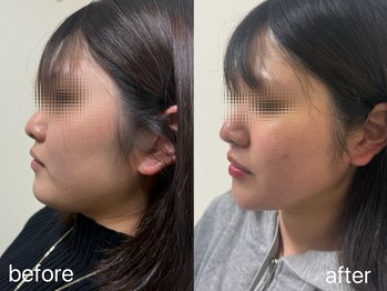 salon emma 【フェイシャルサロン&ネイルサロン】小顔/たるみ/韓国ネイル/1回目の1ヶ月が◎脂肪分解