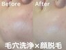 【毛穴洗浄×顔脱毛】毛穴の存在感ゼロ◆ごっそり洗って、閉じる。相乗効果◎