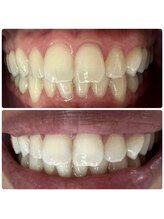 ラブホワイトニング 渋谷店(LOVEホワイトニング)/初回２回照射ホワイトニング