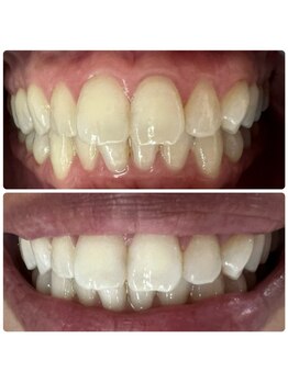 ラブホワイトニング 渋谷店(LOVEホワイトニング)/初回2回照射ホワイトニング