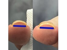 ネイル アトリエ ミジュ(nail atelier MijU)の雰囲気（巻き爪緩和ジェルメニューございます!ご相談ください）
