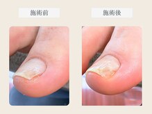 ルポ 伊勢/陥入爪ケア