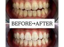 ホワイトニングサロン 宝塚/Before&After美白ホワイトニング