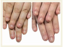 キュアネイル(Qa Nail)/ハンド【深爪矯正】初日変化！