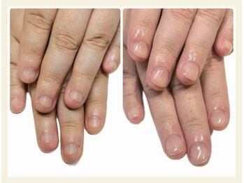 キュアネイル(Qa Nail)/ハンド【深爪矯正】初日変化！