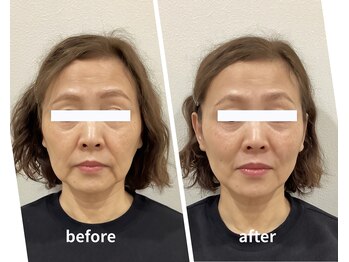 スリー治療院 伏見桃山(THREE治療院)/【ほうれい線改善】小顔矯正