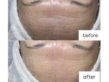 オルネ(ORNE.)/《セラピール》