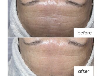 オルネ(ORNE.)/《セラピール》