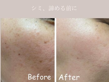 シミケア×大人の肌質改善sol.高槻【光フェイシャル/たるみ/毛穴/シワ/美白】の写真/ファンデで隠す毎日から、素肌に自信を。シミくすみハリ不足…40代から増える肌悩みをまとめてケア