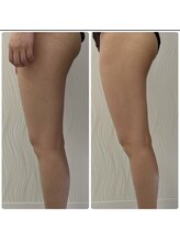 ソルニス(Solnis.)/痩身☆脂肪分解/ハイパーナイフ