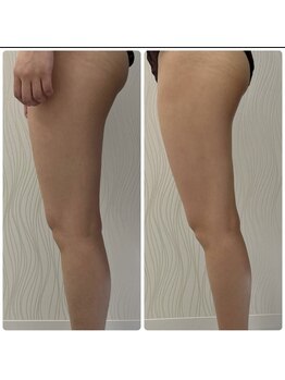 ソルニス(Solnis.)/痩身☆脂肪分解/ハイパーナイフ