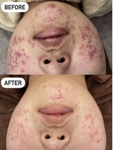 ホワイトアイ 北谷(WHITE EYE)/【肌質改善ハーブピーリング】