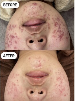 ホワイトアイ 北谷(WHITE EYE)/【肌質改善ハーブピーリング】