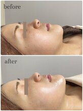 ルシアル(Rucial)/ハーブピーリング◇Before/After