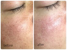 シェミー(CHEZ MEE)/【メンズ美容】毛穴/ニキビケア