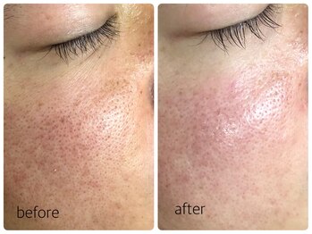 シェミー(CHEZ MEE)/【メンズ美容】毛穴/ニキビケア