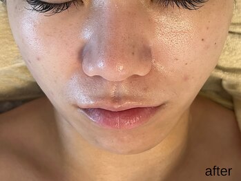 サロン ド エメ(salon de aimer)/【After】透明感、毛穴縮小!