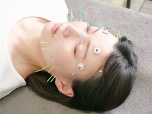 ラフテル鍼灸整骨院/美容鍼スタンダードコース♪