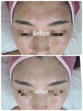 サロン ド ハニー(Salon de Honey)/ハーブピーリング