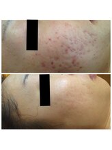 ビューティーアンドボディメイクBB シャオ西尾店/肌荒れ改善