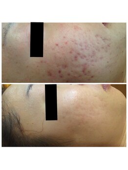 ビューティーアンドボディメイクBB シャオ西尾店/肌荒れ改善