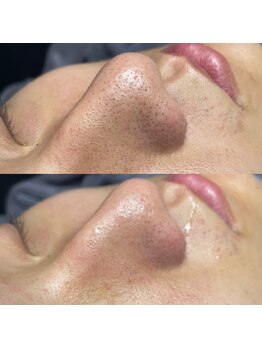 ニューフェイス(NEW FACE)/毛穴洗浄