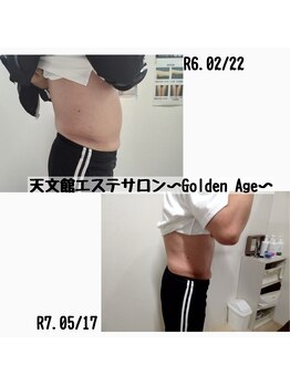 ゴールデンエイジ(Golden Age)/下腹肉を脂肪冷却でスッキリ★